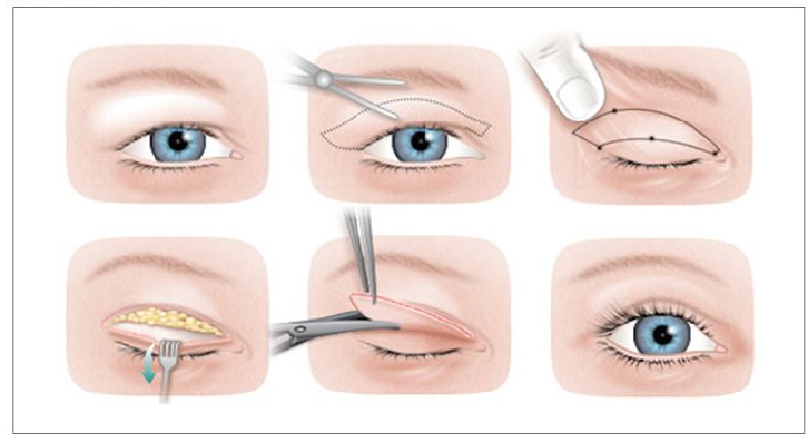 تصویر مراحل انجام جراحی پلک 