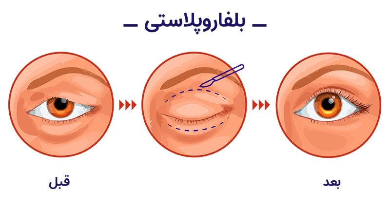 عکس مراحل بلفاروپلاستی