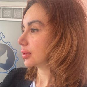 ساکشن غبغب در مشهد