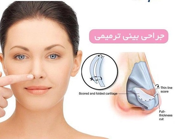 جراحی بینی ترمیمی در مشهد