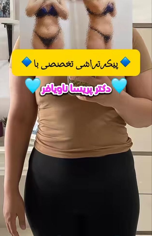 عکس نمونه عمل لیپوماتیک دکتر پریسا ناویافر