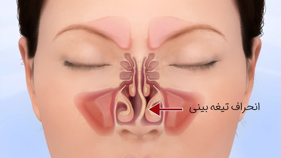 عکس انحراف بینی 