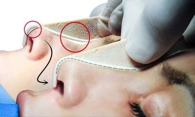 نحوه انجام عمل بینی با قالب کنترلی
