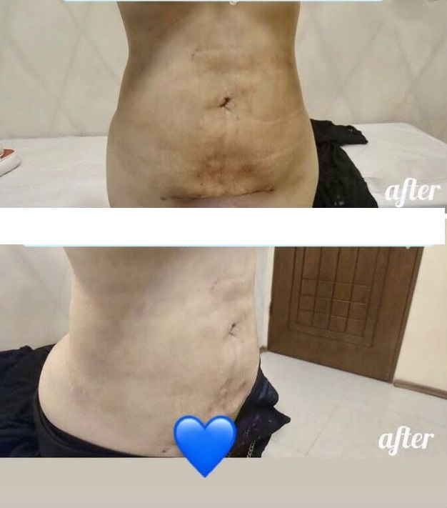 نمومه عمل لیپوماتیک دکتر علیرضا برجسته