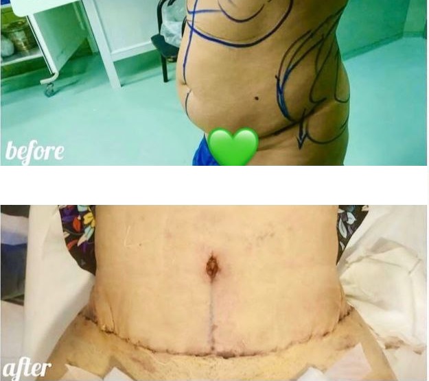 نمومه عمل لیپوماتیک دکتر علیرضا برجسته