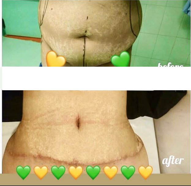 نمومه عمل لیپوماتیک دکتر علیرضا برجسته