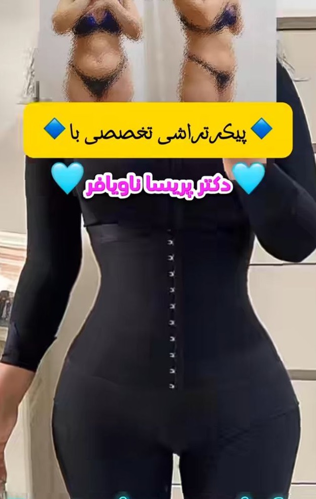 عکس نمونه عمل لیپوماتیک دکتر پریسا ناویافر