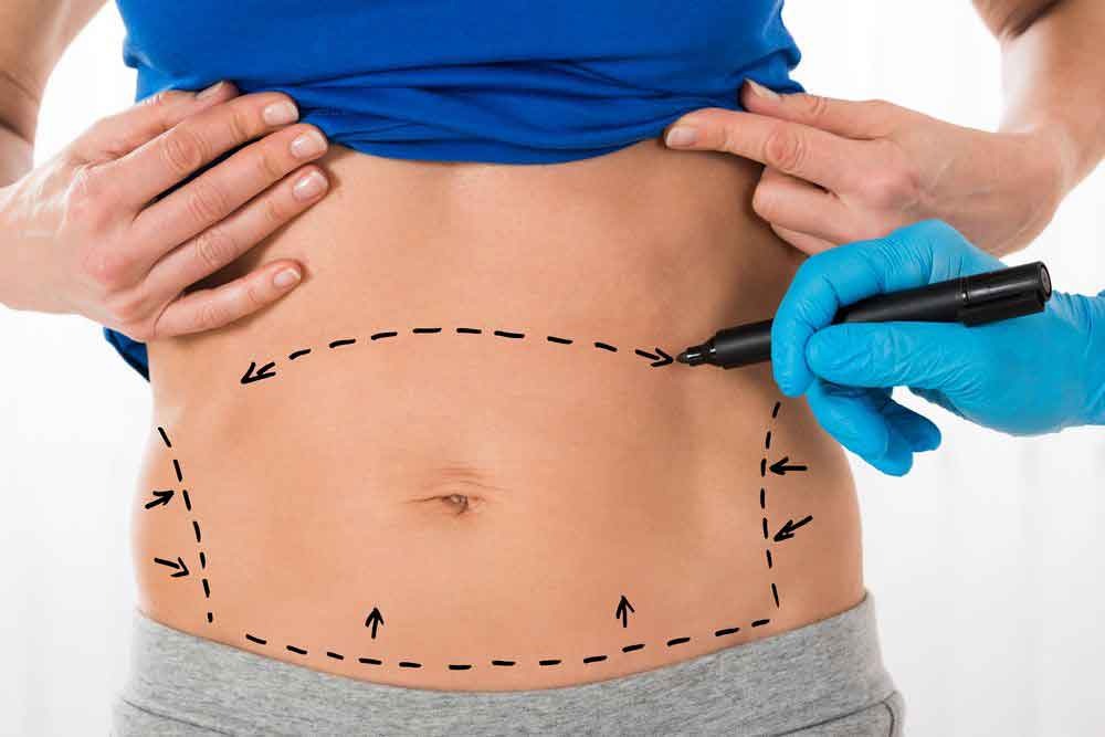 مشخص کردن محدوده لیپوماتیک